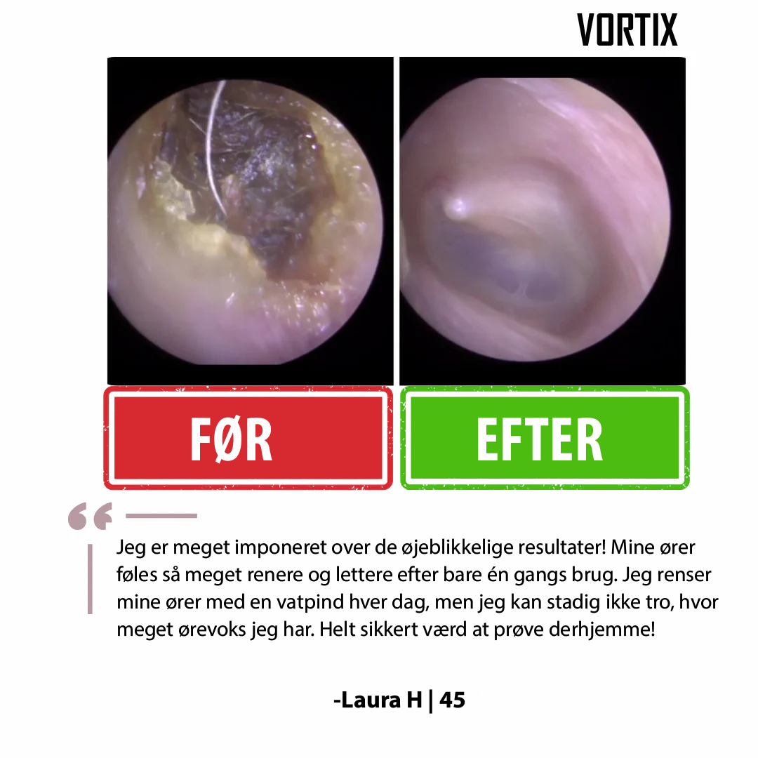 VORTIX sæt til fjernelse af ørevoks