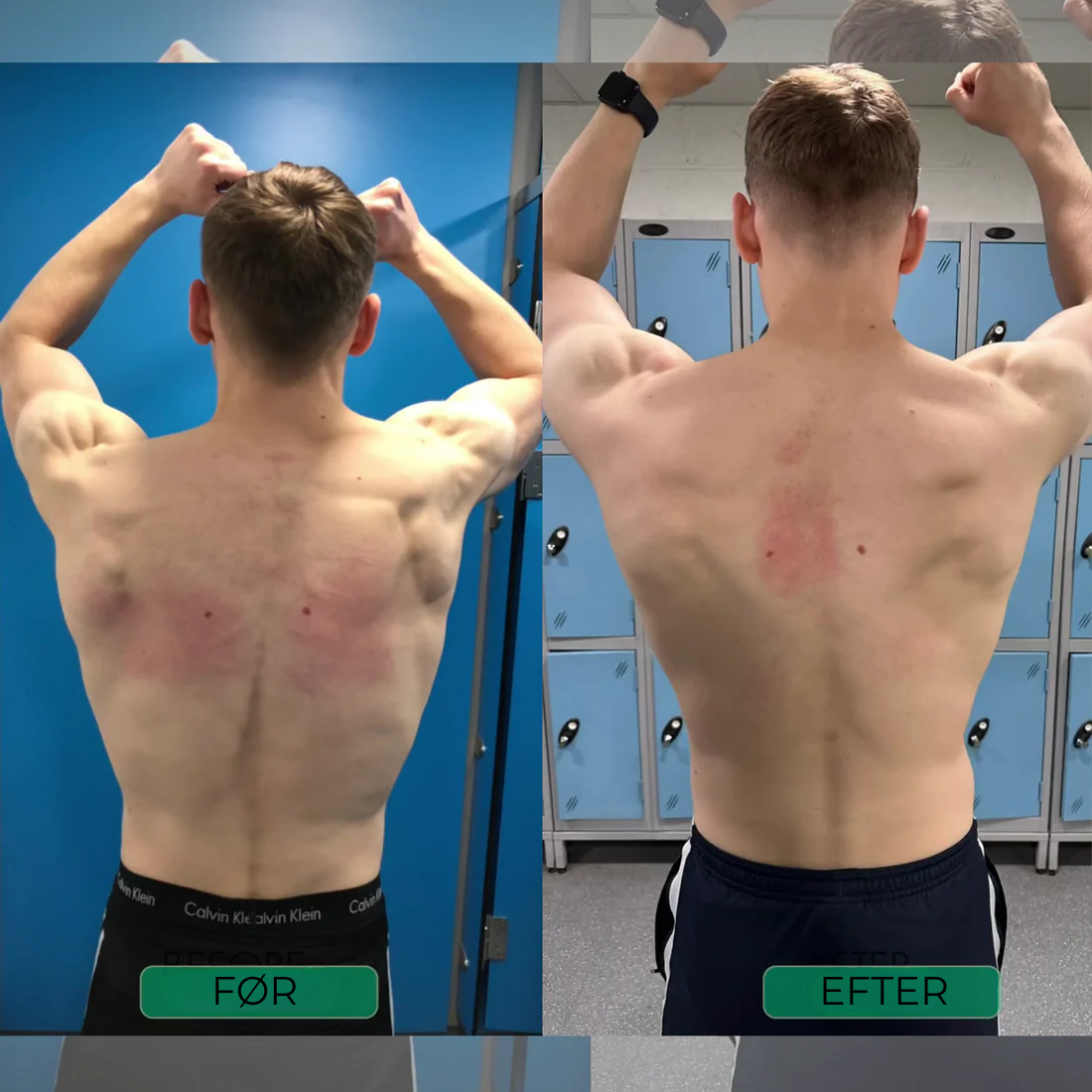 Uprighta™ | Øjeblikkelig Holdningskorrektion