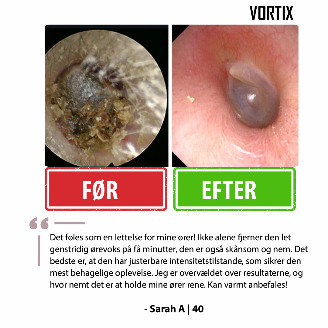 VORTIX sæt til fjernelse af ørevoks